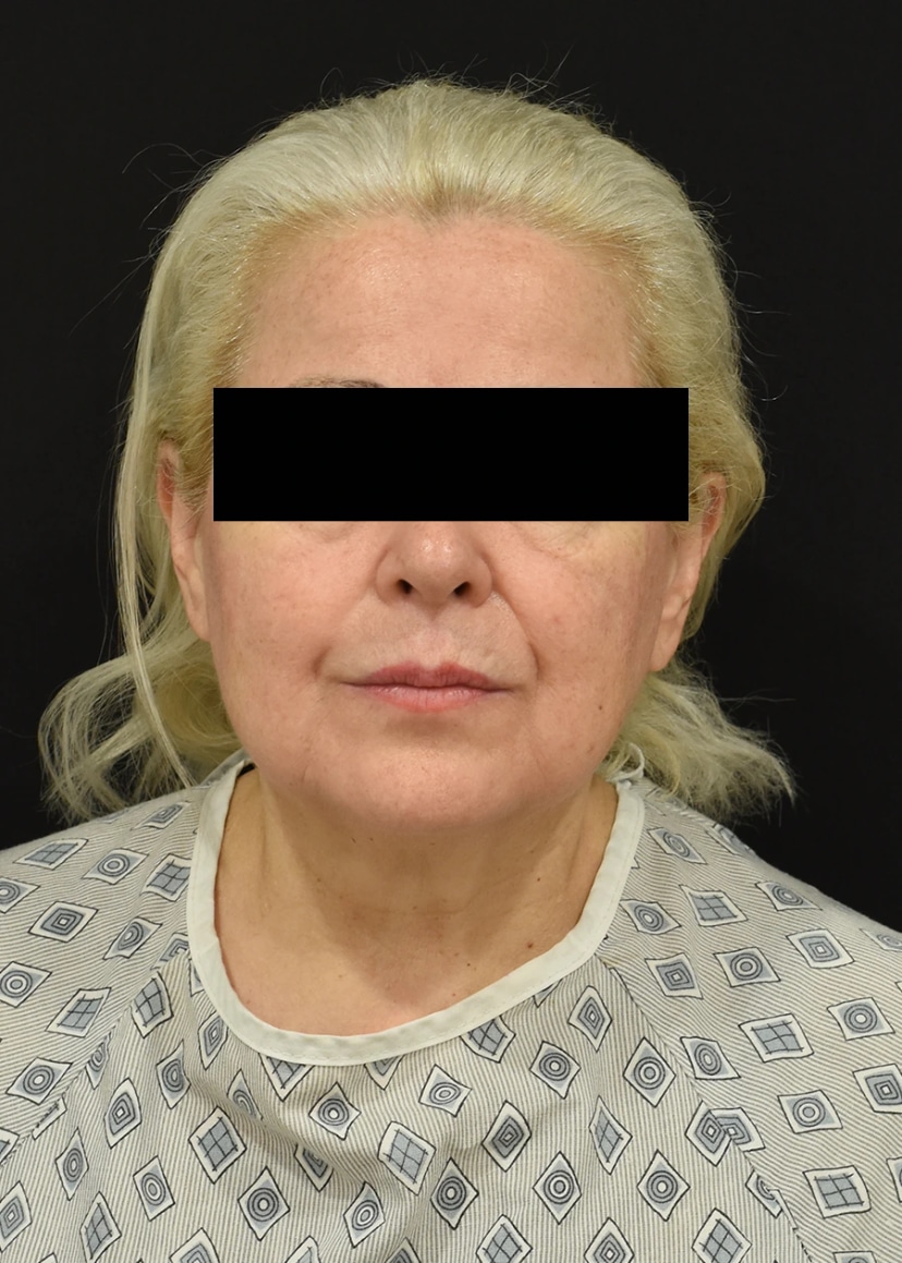 Neck Lift Patient 23 Set 1 Before